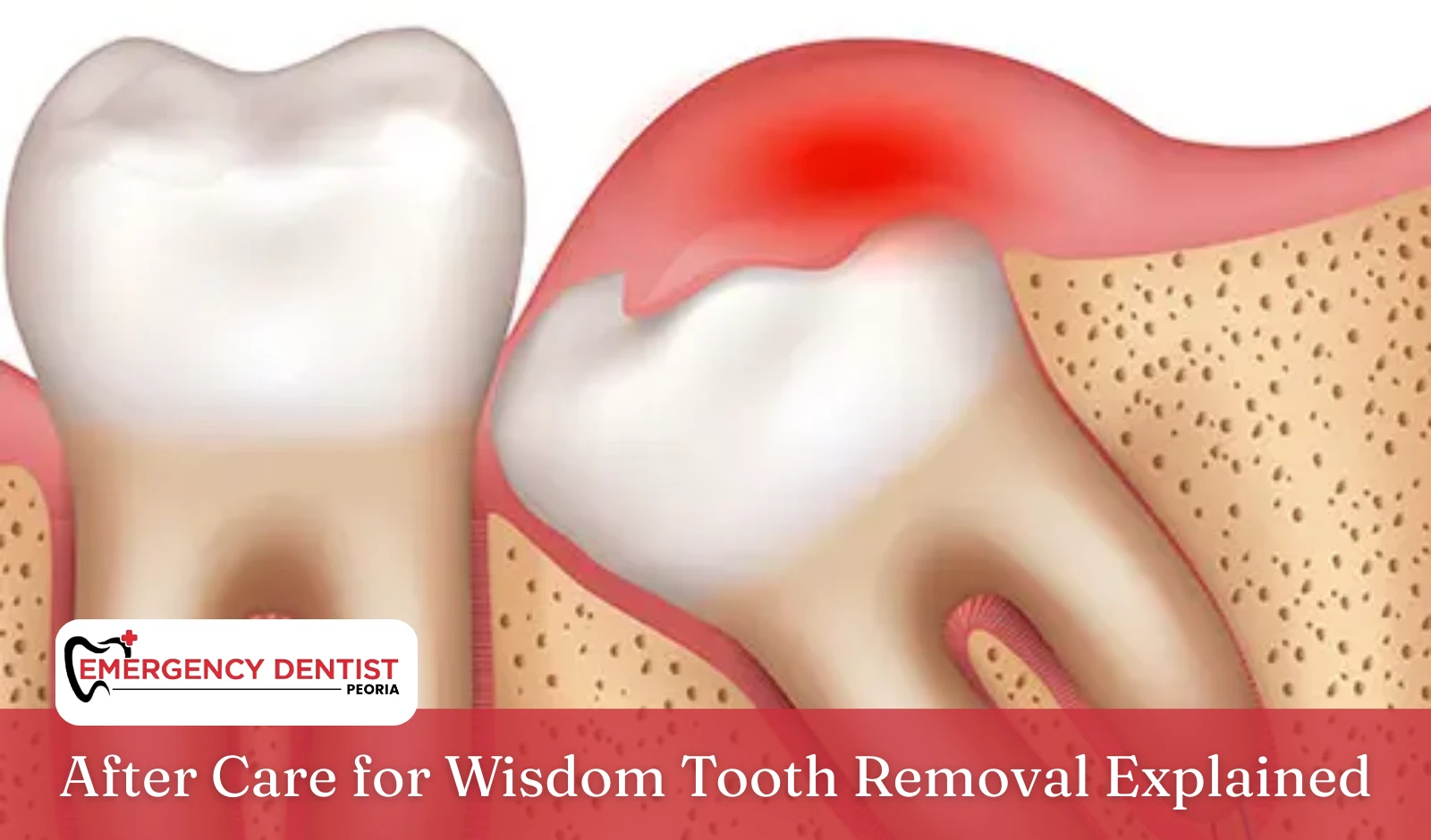 After Care for Wisdom Tooth Removal Explained