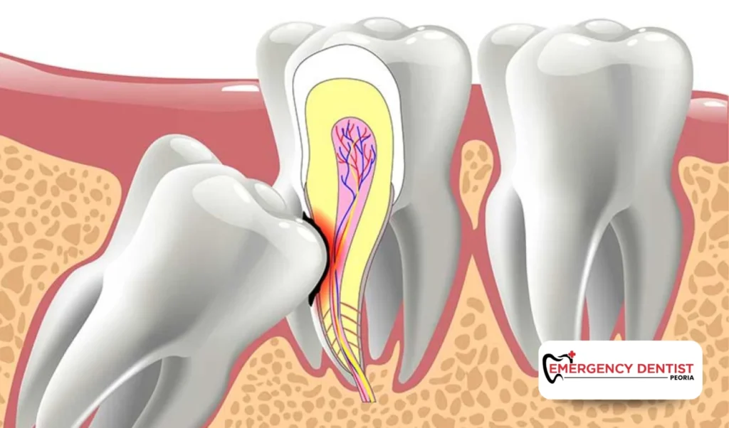 When Wisdom Teeth Removal May Be Recommended