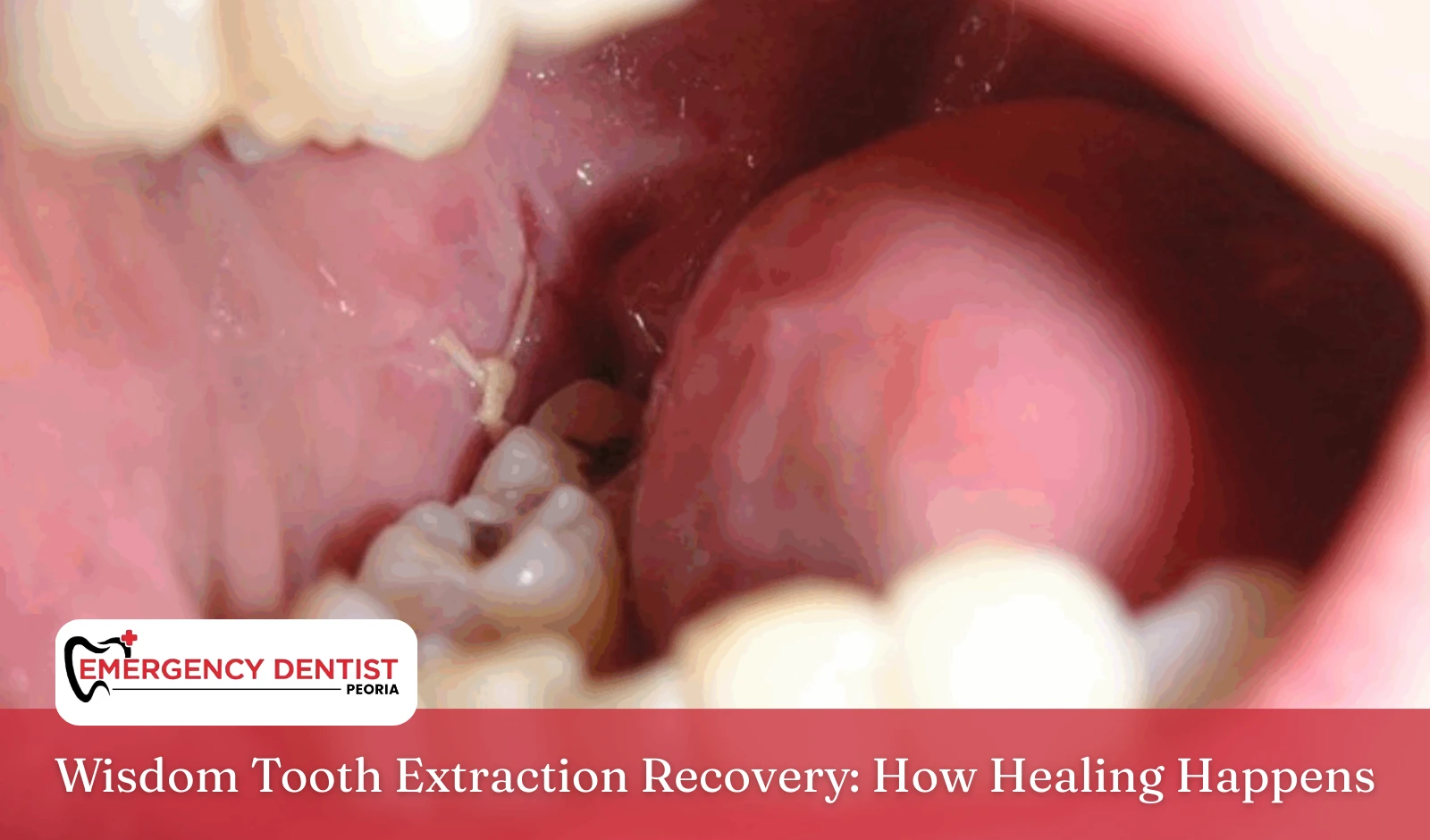 Wisdom Tooth Extraction Recovery How Healing Happens