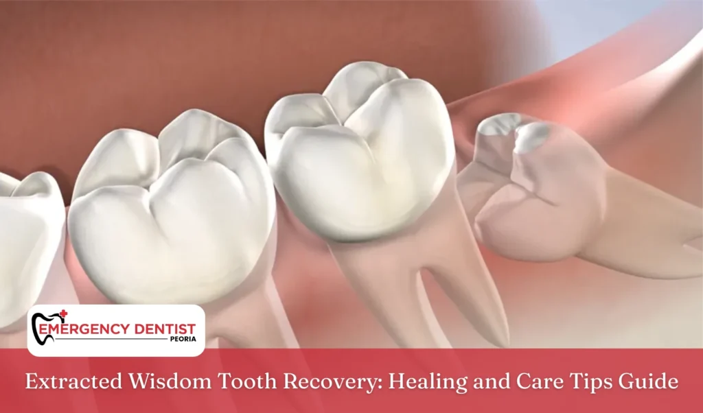 Extracted Wisdom Tooth Recovery Healing and Care Tips Guide