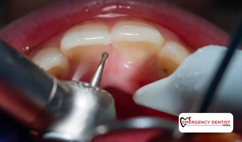 Tooth Pain After Filling Sensitivity or Something More