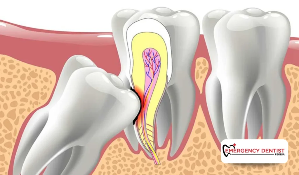 Why Wisdom Tooth Removal May Be Needed