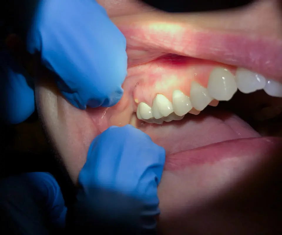 Abscesses-or-Infections-Peoria-AZ