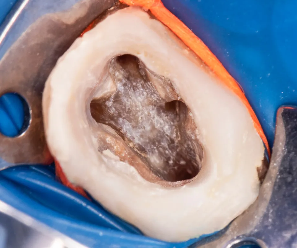 Cleaning-the-Root-Canal-Peoria-AZ