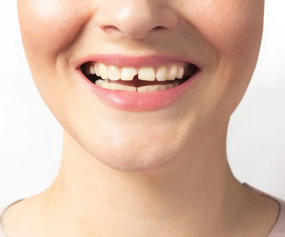 Cracked-or-Broken-Teeth-Peoria-AZ