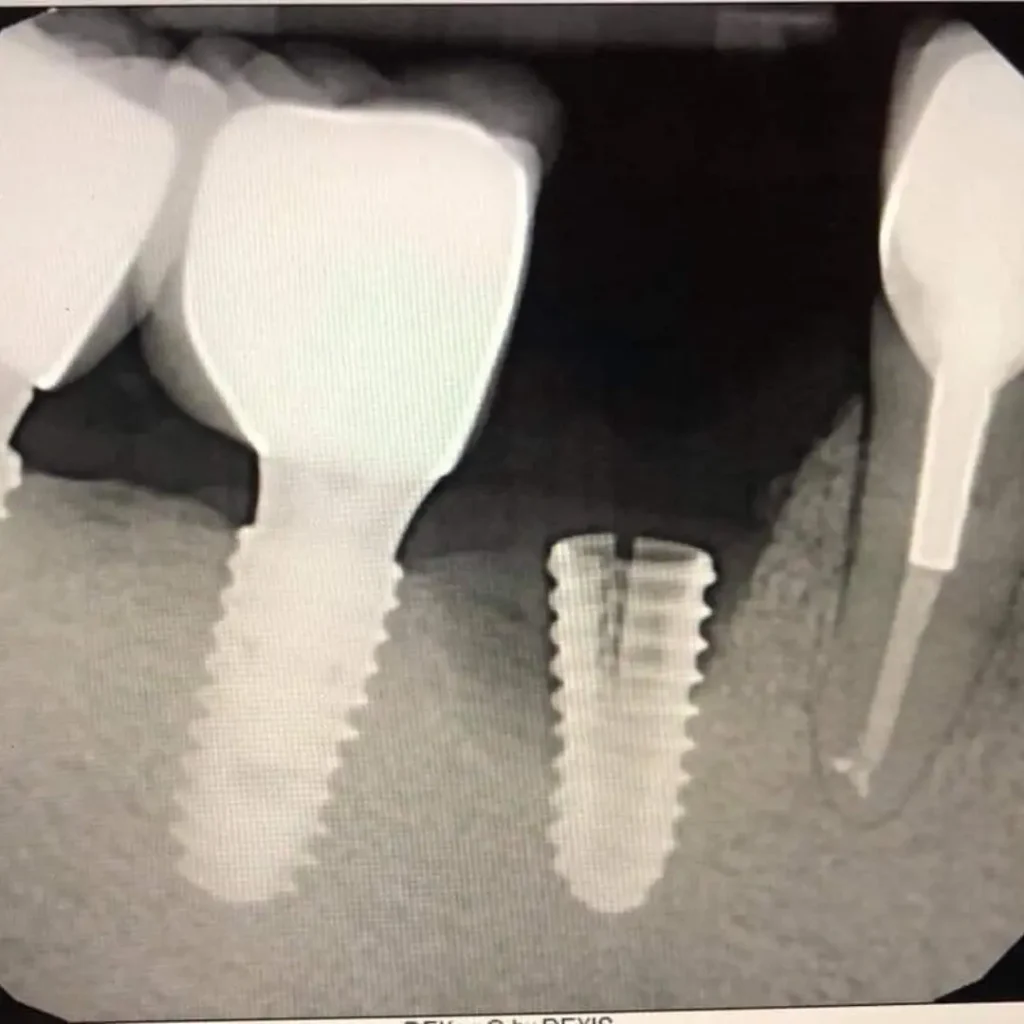 Cracked-or-fractured-implants-Peoria-AZ