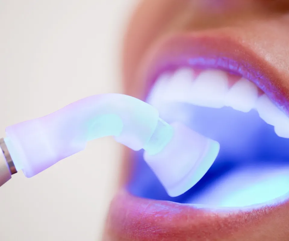 Dental-Bonding-or-Filling-Peoria-AZ