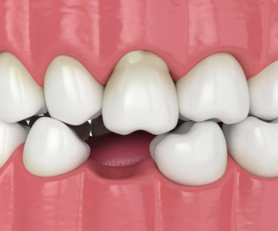 Dislocated-Teeth-Peoria-AZ