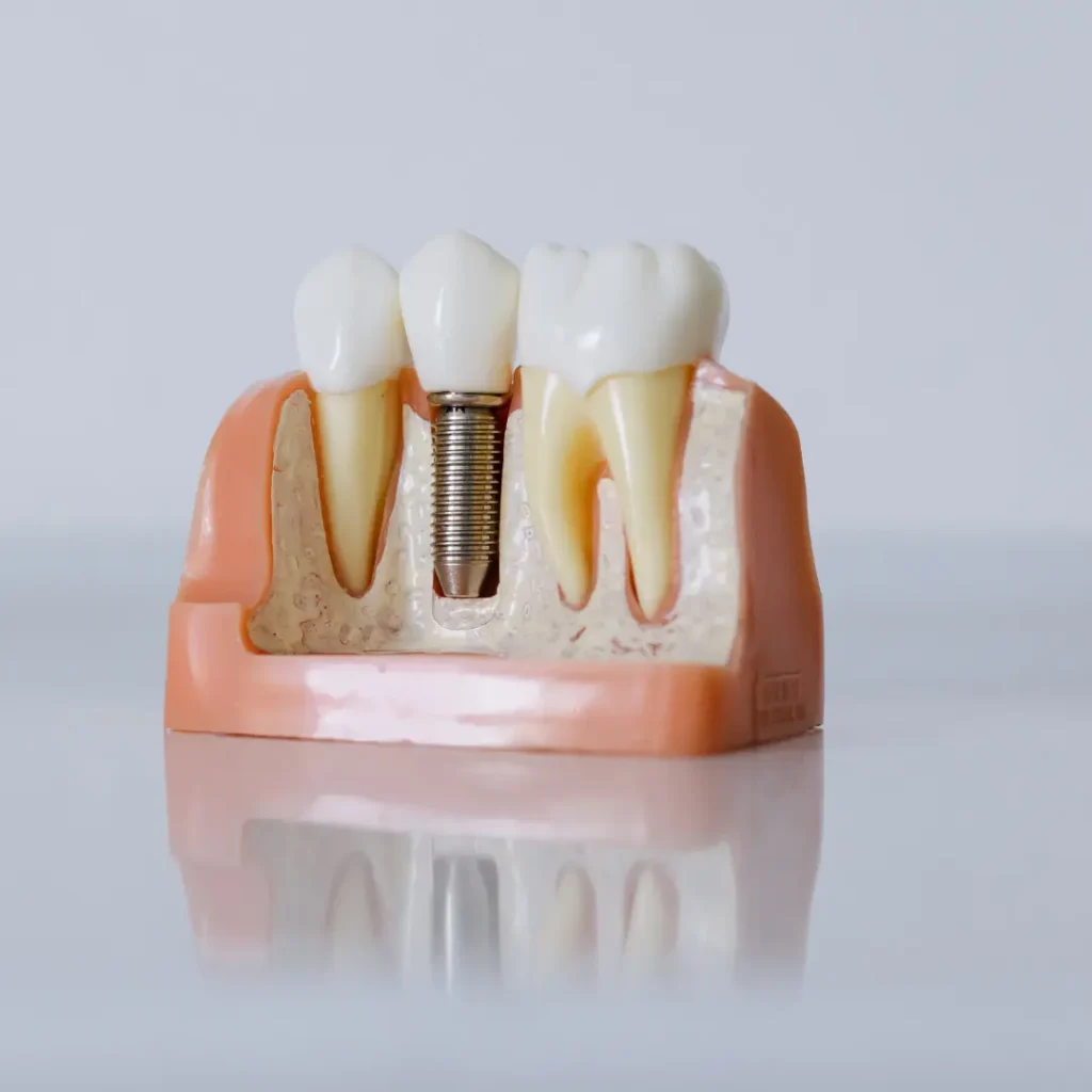 Emergency-Dental-Implant-Peoria-AZ