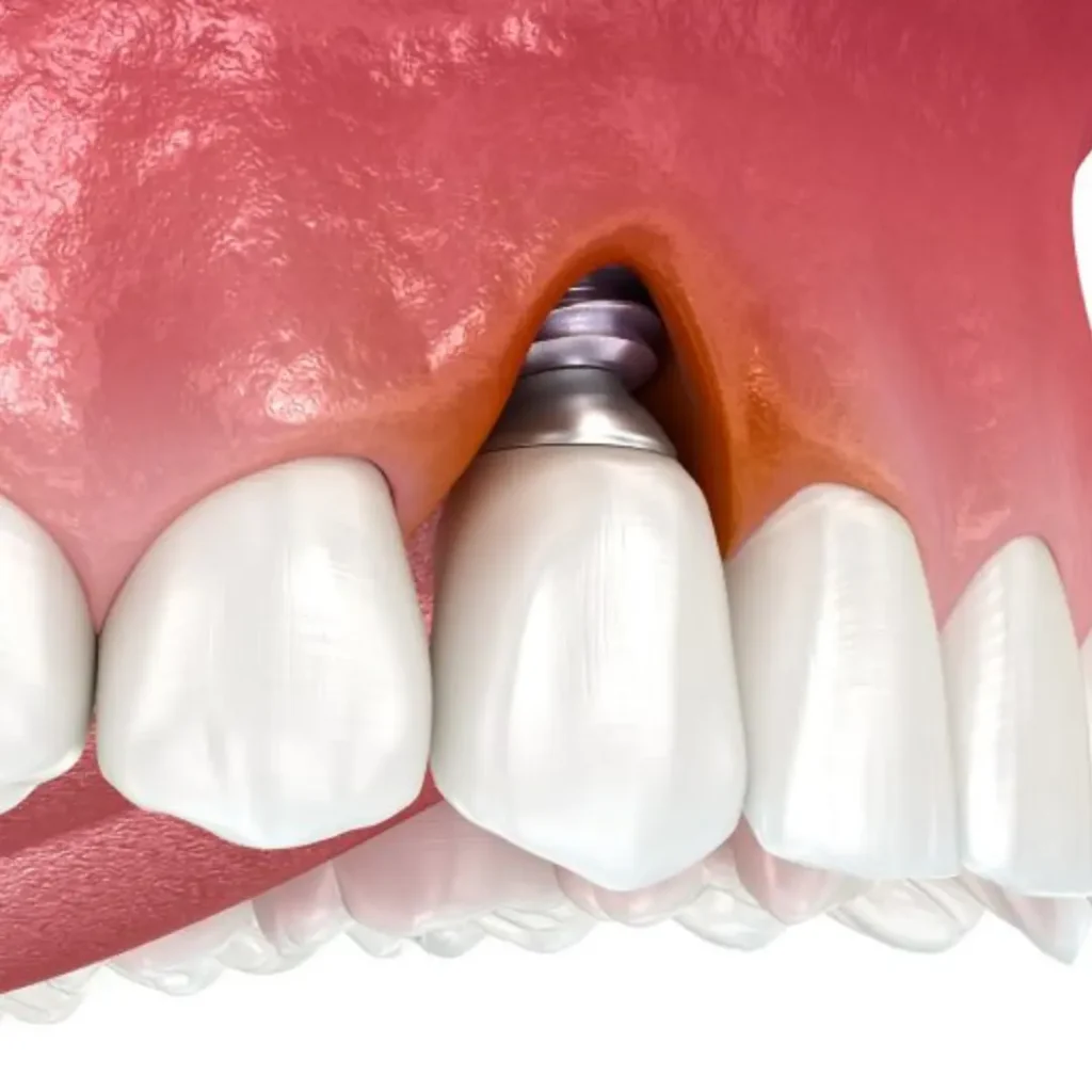 Infection-or-pain-around-an-implant-Peoria-AZ