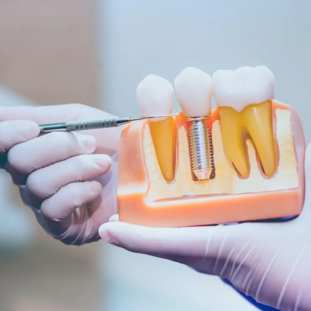 Loose-or-shifting-dental-implants-Peoria-AZ