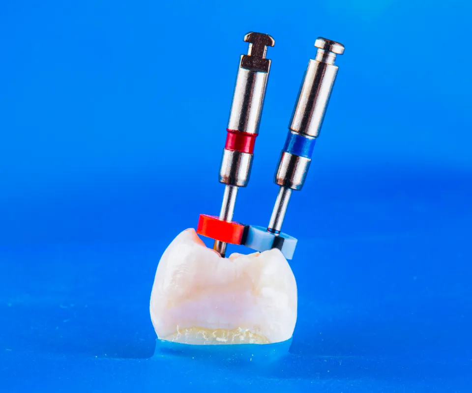 Root-Canal-Treatment-Peoria-AZ