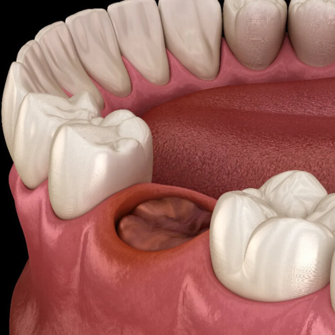 Symptoms-of-Dry-Socket-Peoria-AZ