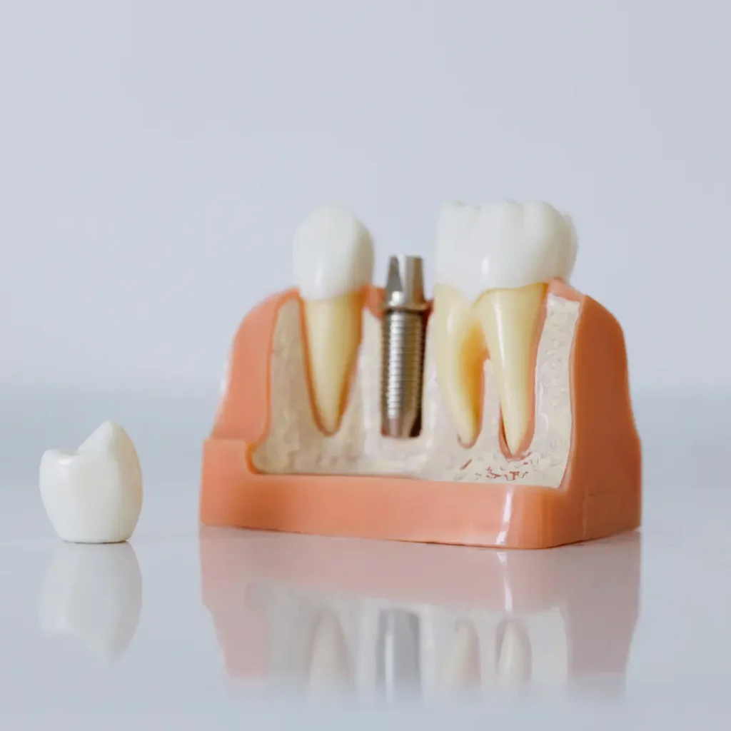 The-implant-crown-fell-off-or-broke-Peoria-AZ