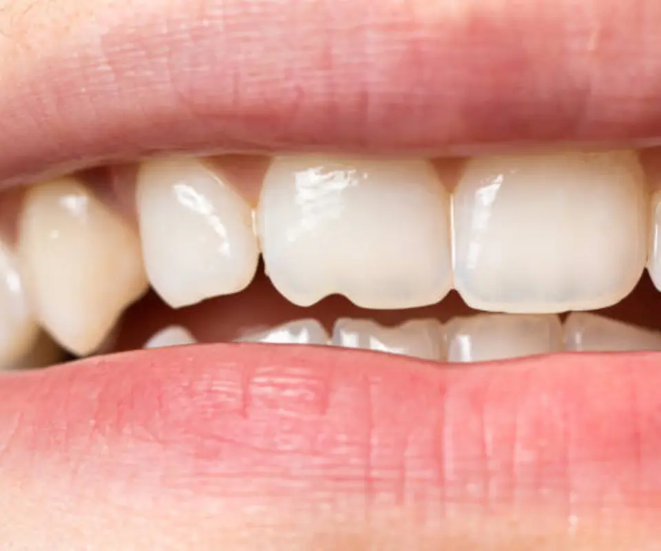 Tooth-Fractures-Peoria-AZ