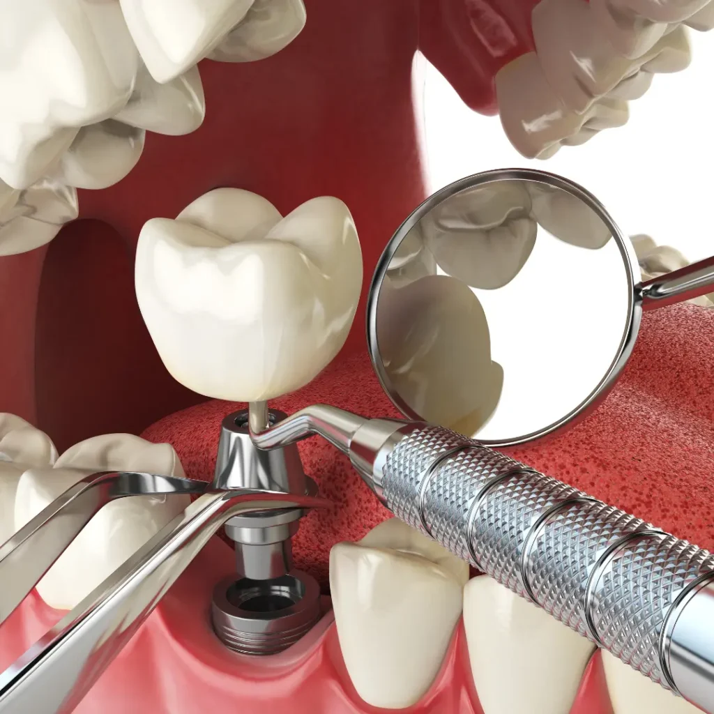 Trauma-related-tooth-loss-needs-immediate-implants-Peoria-AZ