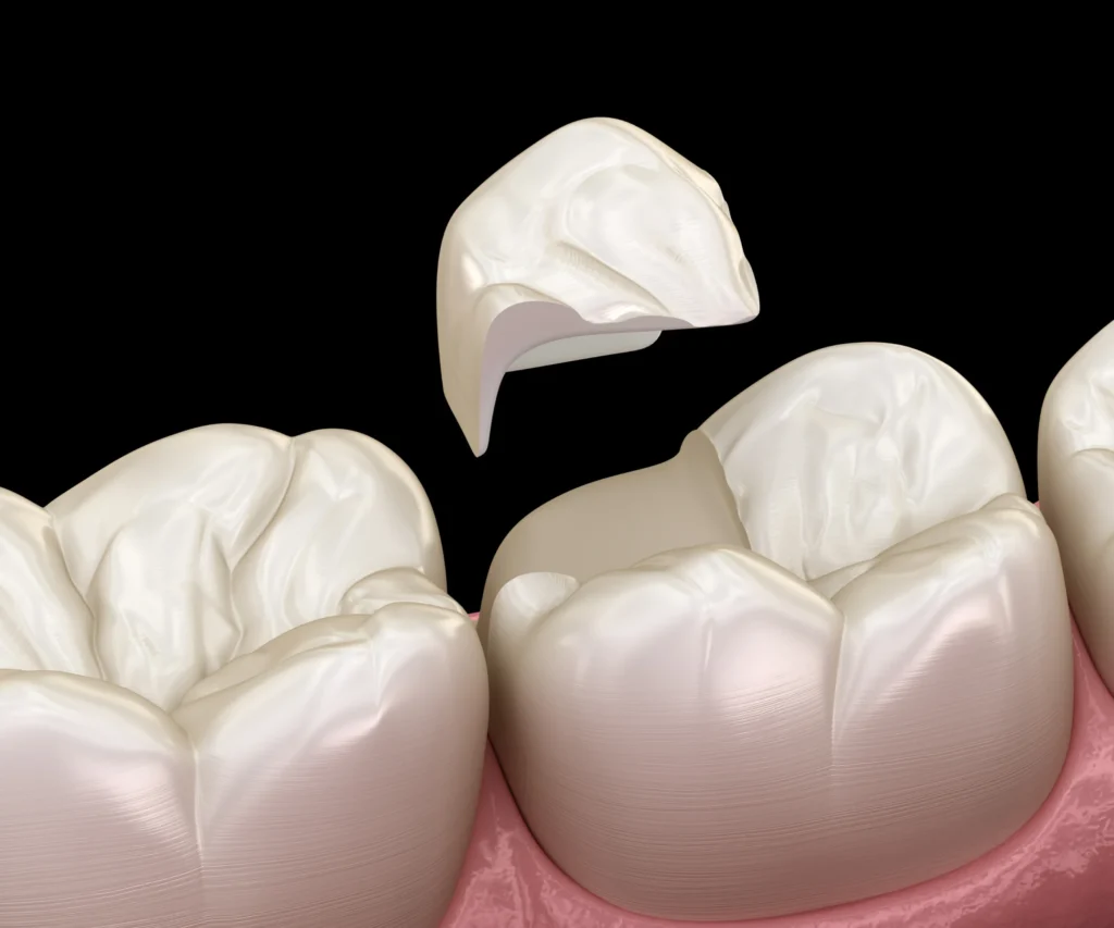What-Causes-a-Cracked-Tooth-Peoria-AZ