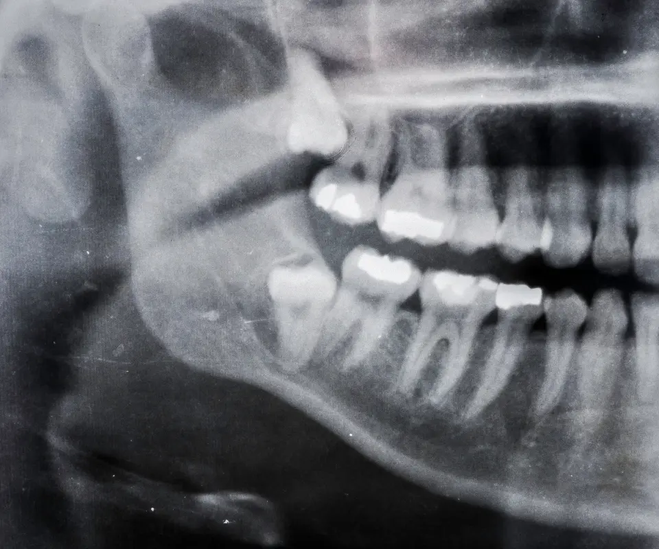 Wisdom-Tooth-Complications-Peoria-AZ