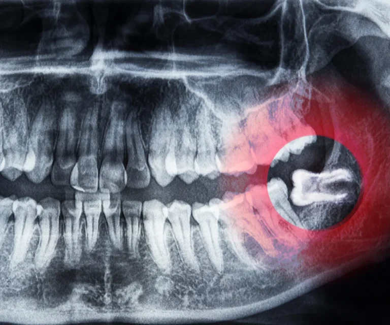 Wisdom-Tooth-Infection-Emergencies-Peoria-AZ
