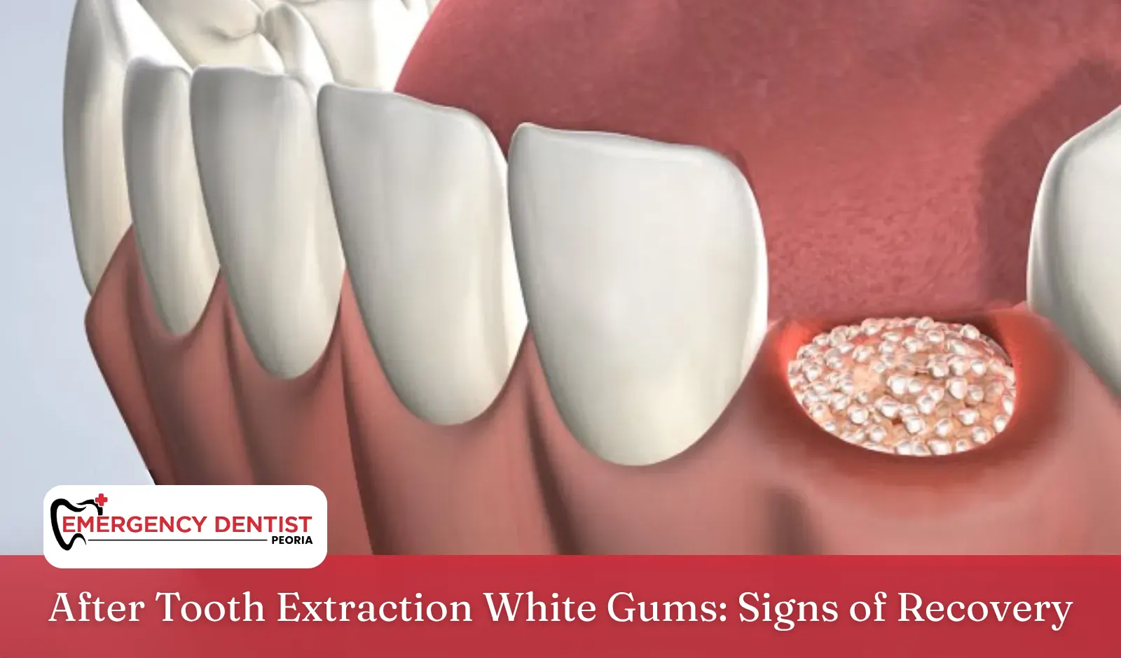 After Tooth Extraction White Gums: Signs of Recovery
