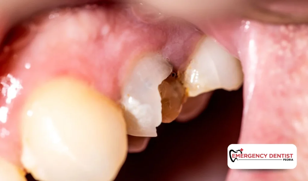 How Can a Back Tooth Chip Without Causing Pain