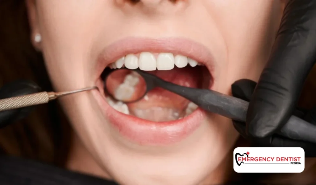 How Might a Dentist Repair a Chipped Back Tooth